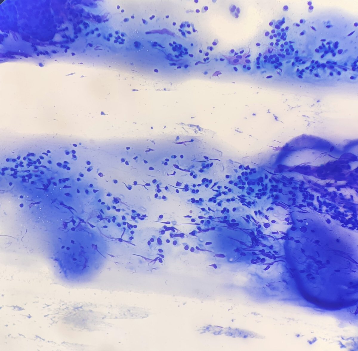 Quique_rs's tweet image. Female, 33 yo. Right thyroid lobe lump. #cytopath #fnapath