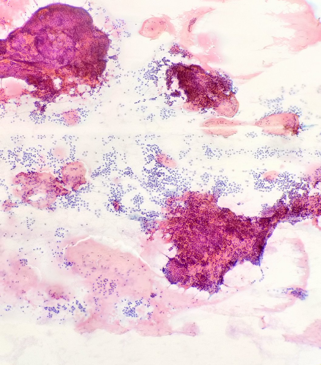 Quique_rs's tweet image. Female, 33 yo. Right thyroid lobe lump. #cytopath #fnapath