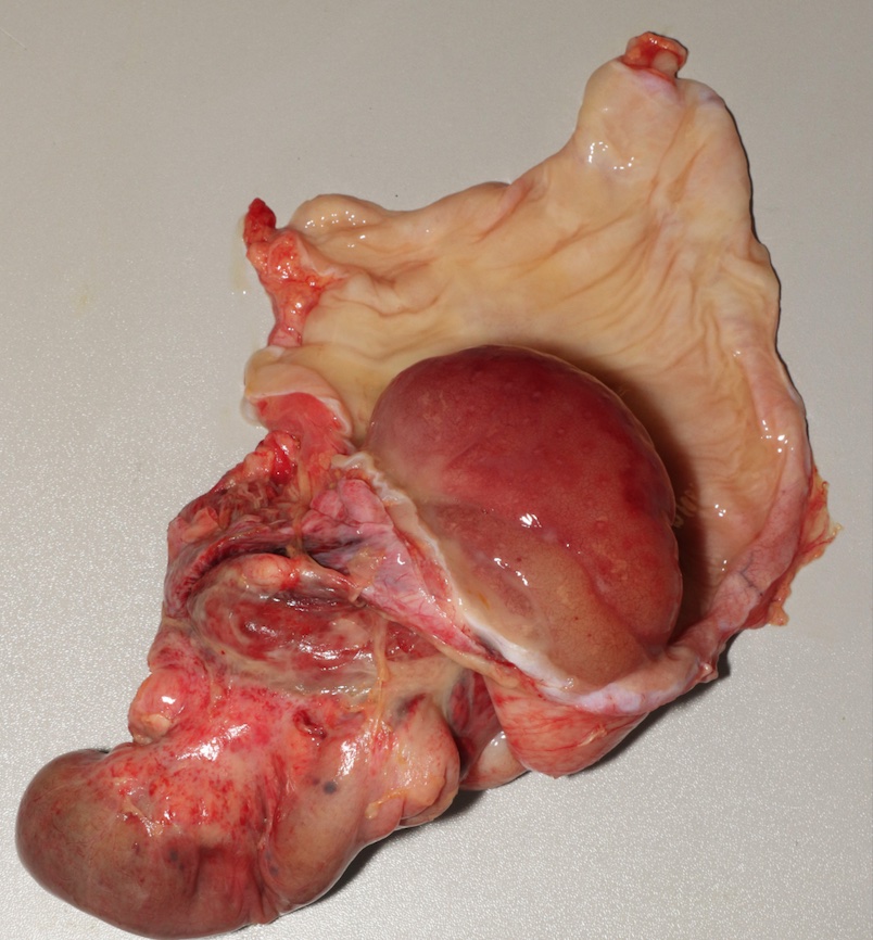 theNAME1966's tweet photo. Case of the Week: A 12-year-old boy presents to the hospital with abdominal pain, nausea and vomiting, and dehydration. Several days later he went into cardiopulmonary arrest.  What is the most likely diagnosis?
https://t.co/tPhGclBbwU https://t.co/J9RD0mllk6