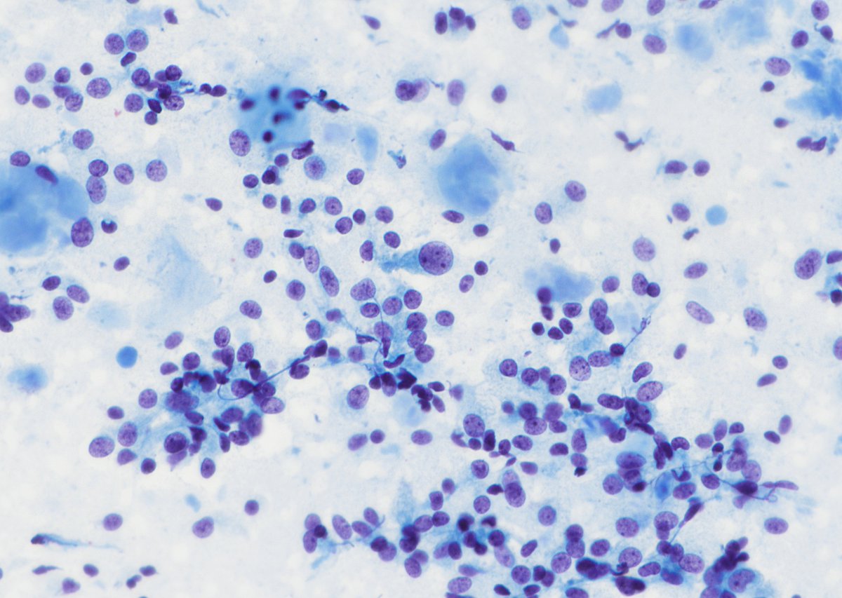 NHardy_path's tweet photo. Medullary thyroid carcinoma – hypercellular FNA of mostly dyshesive, plasmacytoid cells w/ neuroendocrine chromatin, red granules (arrow), and admixed amorphous material. Calcitonin+/chromo+ and congo red+ amyloid w/ apple green birefringence (shown). Can trigger workup for MEN2. https://t.co/faJOIK6n2t