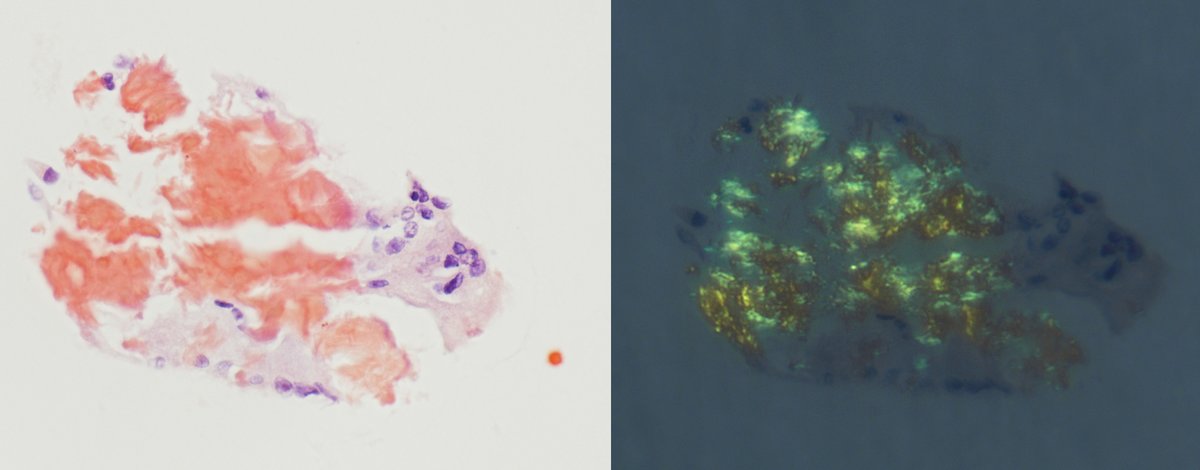 NHardy_path's tweet photo. Medullary thyroid carcinoma – hypercellular FNA of mostly dyshesive, plasmacytoid cells w/ neuroendocrine chromatin, red granules (arrow), and admixed amorphous material. Calcitonin+/chromo+ and congo red+ amyloid w/ apple green birefringence (shown). Can trigger workup for MEN2. https://t.co/faJOIK6n2t