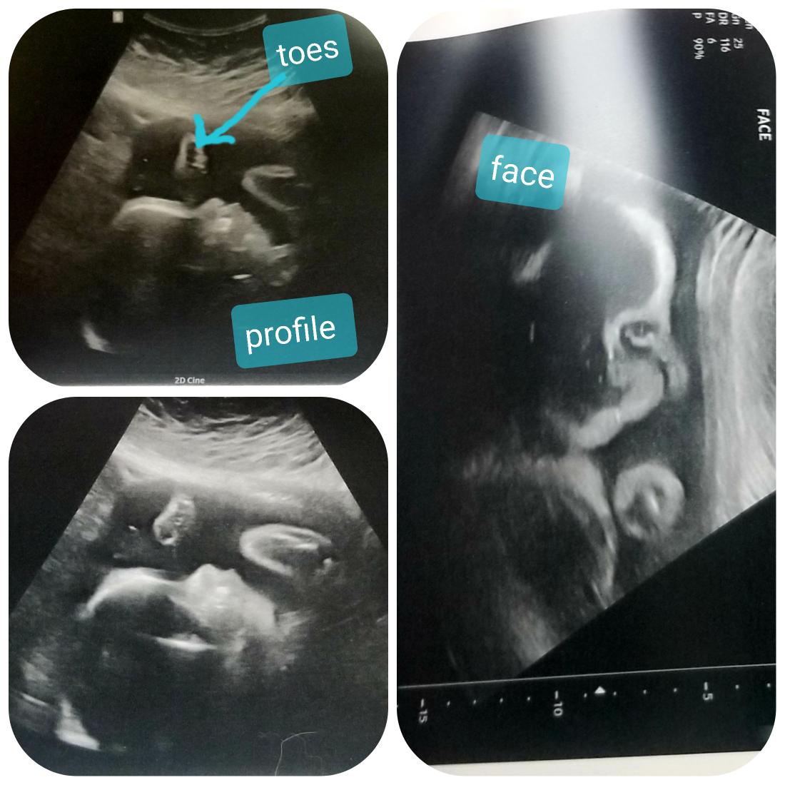 the_winfrees's tweet image. We had a 28 week ultrasound today and got to see our son! He has grown so much. His little toes were up by his face when she snapped the photo. For those who are new to our page and story, after 9 yrs of infertility, we felt God was leading us to adopt embryos and it worked! 🙏❤