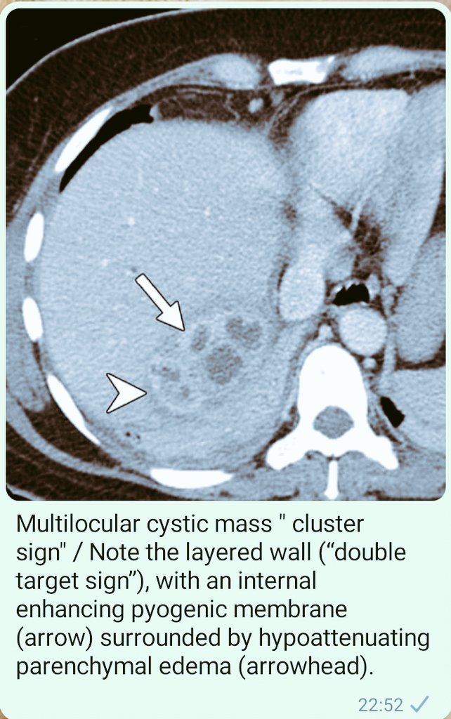 The "cluster sign" is a feature of pyogenic hepatic abscesses,  particularly of biliary origin, in US / CT ...
The double target sign is a characteristic imaging feature of liver abscess on contrast-enhanced CT ...
<a href="/neilRsharmaMD/">Neil Sharma, M.D. FASGE, FACG, AGAF</a>
<a href="/KMonkemuller/">Klaus Mönkemüller, MD, PhD</a> <a href="/mharisinghani/">Mukesh Harisinghani</a> <a href="/NephroP/">NephroPOCUS</a> <a href="/Kh_Saidani/">Kadége S</a>