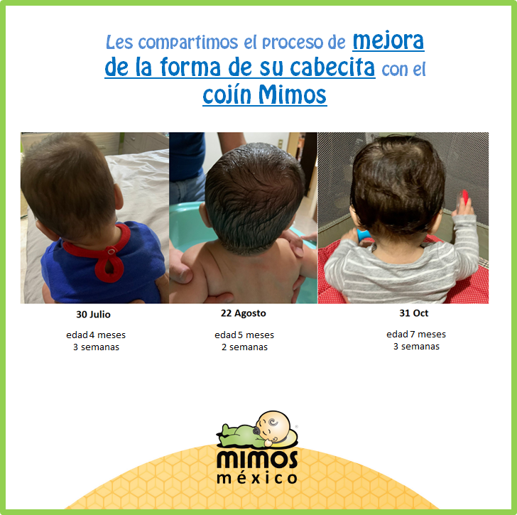Cojin Mimos Mexico - Buenos dias! Les compartimos el resultado del cojín  Mimos después de 2 meses. Entre mas pronto se trate y prevenga la  plagiocefalia posicional o cabeza plana (braquicefalia) en
