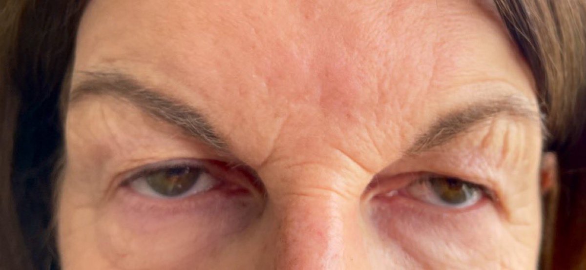 julesserkin's tweet image. One year ago today I made the mistake of following the advice &amp;amp; indeed coercion &amp;amp; propaganda to get the #CovidVaccine: Something I regret bitterly- I’m just in the middle of a 3 day vax attack too- photo my eyes today end of February 21 &amp;amp; February before the jab