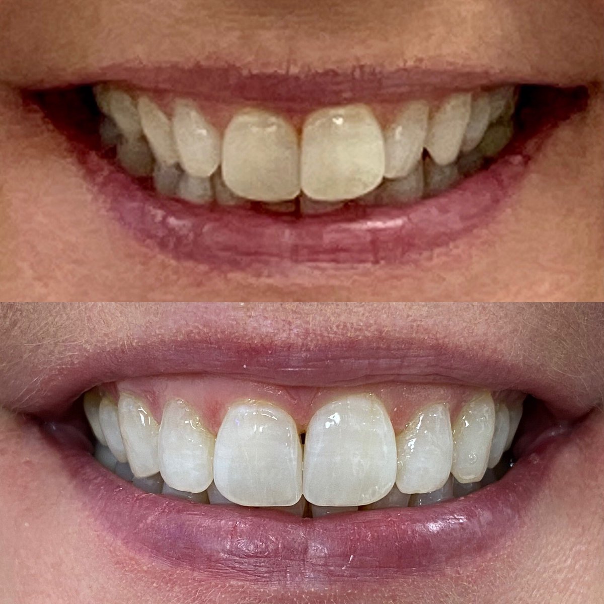 MarquandLe's tweet photo. I would like to thank Dr Louise Brownlow @smile for my amazing teeth transformation using Invisalign liners. I started 11 August 2021 and finished 3 March 2022. I had in total 23 liners. #hollywoodsmile #smile #invisalign #whitedentalbeauty #straightteeth #teethchewies https://t.co/UAS52pfZHC