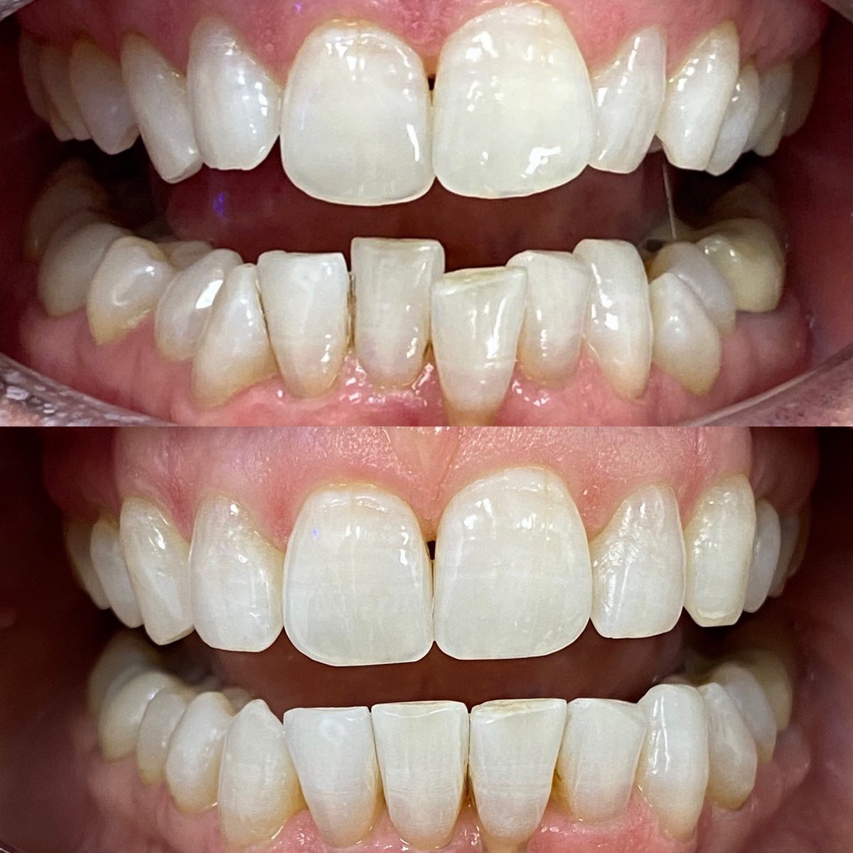 MarquandLe's tweet photo. I would like to thank Dr Louise Brownlow @smile for my amazing teeth transformation using Invisalign liners. I started 11 August 2021 and finished 3 March 2022. I had in total 23 liners. #hollywoodsmile #smile #invisalign #whitedentalbeauty #straightteeth #teethchewies https://t.co/UAS52pfZHC
