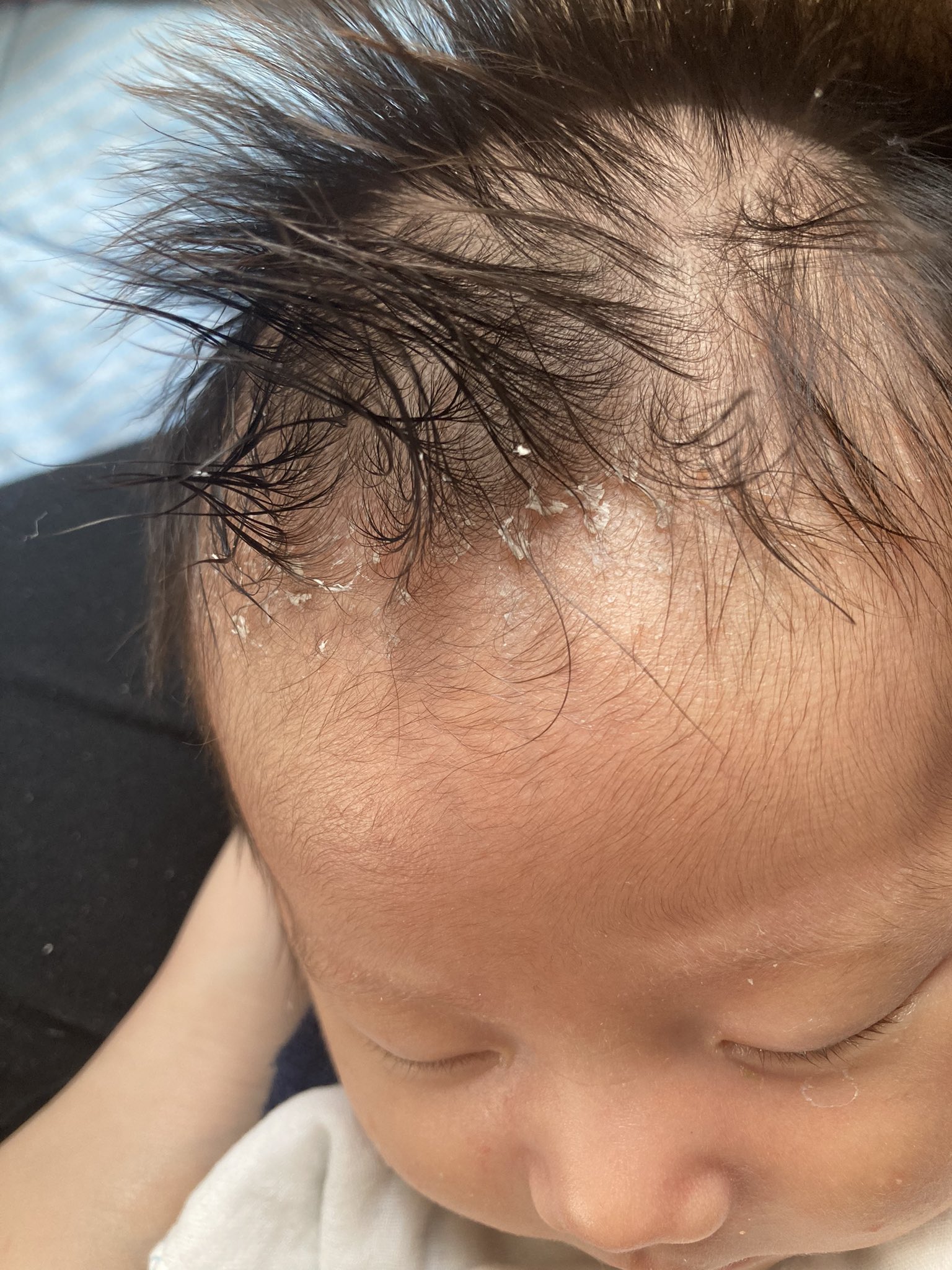 ダイヤモンド 39w5d 3m 昨日 旦那と一緒にお風呂に入っていた我が子ですが ぬるま湯で弱めのシャワーを当てた所 皮膚がふやけて 時間がたったらこんな有様に なので本日 病院に行ってきました 乳児湿疹と脂漏性湿疹と診断され それぞれの塗り薬