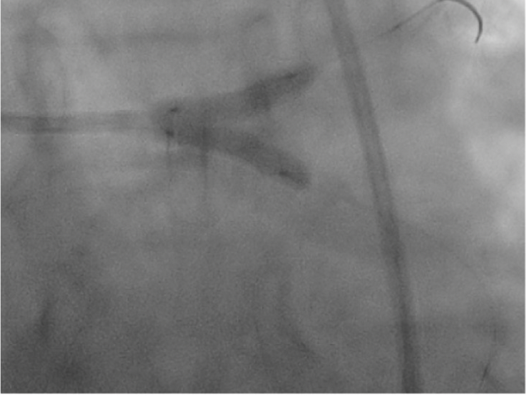 Italian Cardiologists Of Tomorrow (@italian_cot) on Twitter photo 🫀Left anterior descending coronary artery occlusion after balloon aortic valvuloplasty
Read at tinyurl.com/mrxznm2a
#cardiology #interventionalcardiology #cardiologyfellow #cardiologia #echocardiography #cathlab #ECG #cardiovascular #electrocardiography #cardiac #ITcardiology 🫀Left anterior descending coronary artery occlusion after balloon aortic valvuloplasty
Read at tinyurl.com/mrxznm2a
#cardiology #interventionalcardiology #cardiologyfellow #cardiologia #echocardiography #cathlab #ECG #cardiovascular #electrocardiography #cardiac #ITcardiology