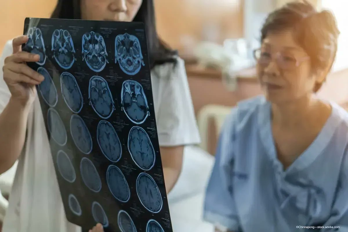 Study proves intra-arterial tissue plasminogen activator beneficial for treatment of central retinal artery occlusion #Ophthalmology #AAO2021 buff.ly/3ol42UM