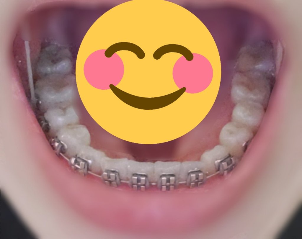 chimu_man's tweet photo. 152日目調整7回目
最終調整って感じで特に前回と変わらない🤣でもみて！このキレイなアーチ！！かなり感動してる！！うまく行けば次回はマウスピースに移行かも！！
でも口のなかのストレスが減ったおかげで食欲に勝てず体重がめちゃくちゃ増えた😭😭😭マウスピースになったら余計増えそう😱
#歯列矯正 https://t.co/hsqYUXG1OX