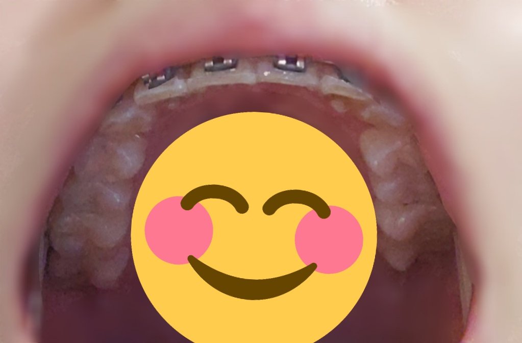 chimu_man's tweet photo. 152日目調整7回目
最終調整って感じで特に前回と変わらない🤣でもみて！このキレイなアーチ！！かなり感動してる！！うまく行けば次回はマウスピースに移行かも！！
でも口のなかのストレスが減ったおかげで食欲に勝てず体重がめちゃくちゃ増えた😭😭😭マウスピースになったら余計増えそう😱
#歯列矯正 https://t.co/hsqYUXG1OX