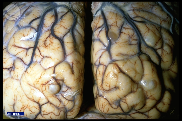 EAnofel's tweet photo. 🦠Picture of the day: Brain cysticercosis. Cysticercus appears as ovoid, translucent vesicles each containing a single larval stage of Taenia solium (tapeworm). Interested in pictures of parasites and associated diseases ?👉Register at https://t.co/oJFxGyrjhh. #thinkparasite https://t.co/4yKe7nOb35