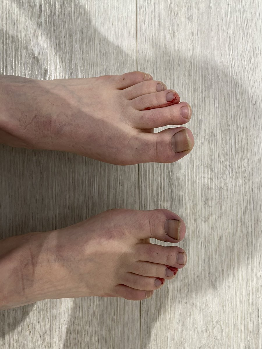 jenthedietitian's tweet photo. I officially have runners feet !! 13.1 miles β¦ I got a shock when I took my trainers off. Must check nails more frequently! π @UKRunChat #run #InternationalWomensDay #RunningAMarathon #running https://t.co/LELF0xNLJS