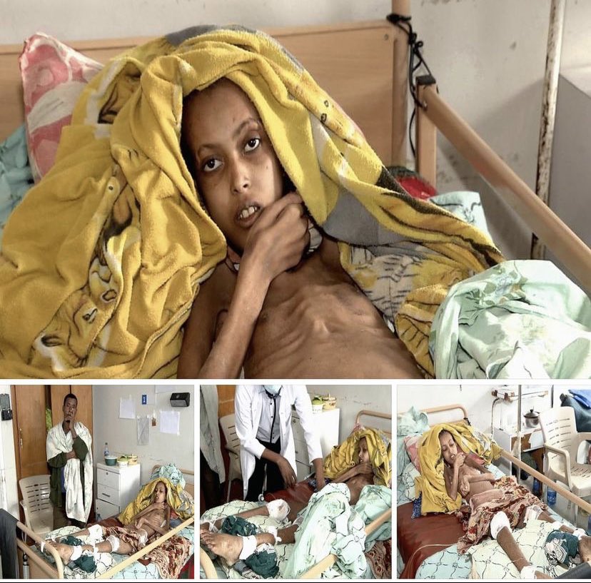 TmesegenT's tweet photo. Children are dying at home from severe malnutrition - says a doctor from Semema Hospital in #Tigray The lack of fuel is a direct consequence of the blockade orchestrated by @AbiyAhmedAli. #TigrayGenocide #TigrayCantWait @vickyford https://t.co/o9WSzpANFg