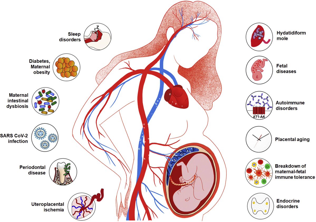 AJOG Expert Review in Preeclampsia:  The etiology of preeclampsia ow.ly/iPwq50IaTUl ajog.org/article/S0002-…