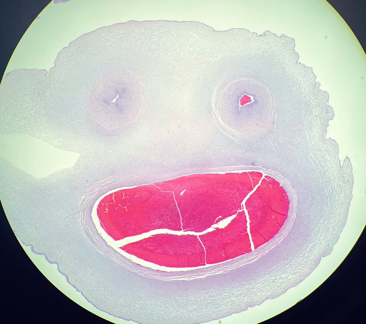 NRiddleMD's tweet photo. One of these umbilical cords is happy it has no #funisitis. The other one... Not so much #Chorioamnionitis with marked fuisitis. https://t.co/lmeZVydbsq