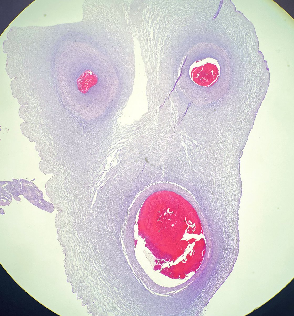 NRiddleMD's tweet photo. One of these umbilical cords is happy it has no #funisitis. The other one... Not so much #Chorioamnionitis with marked fuisitis. https://t.co/lmeZVydbsq