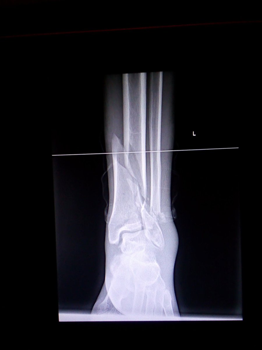 RNgosa's tweet photo. @pulte This would help and change the life of Solomon who needs to undergo surgery for his broken leg requires $900.I would appreciatee the help.Paypal Reston Ngosa https://t.co/lcFEjpD2GG