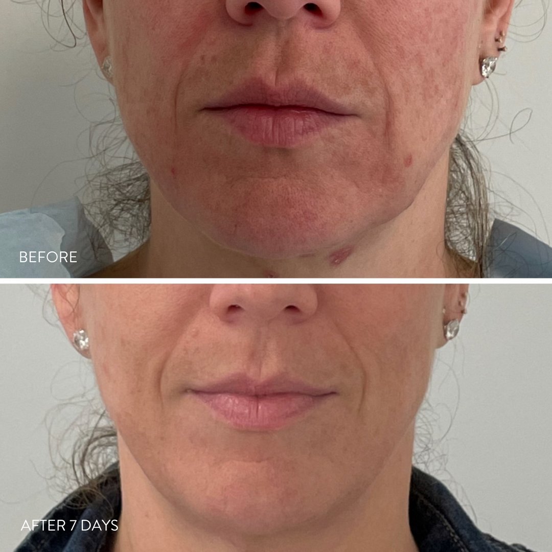 The HALO Laser by <a href="/sciton/">Sciton Inc.</a> is one of the many innovative machines used at Lancer Dermatology to deliver real, remarkable results. #LancerGlow