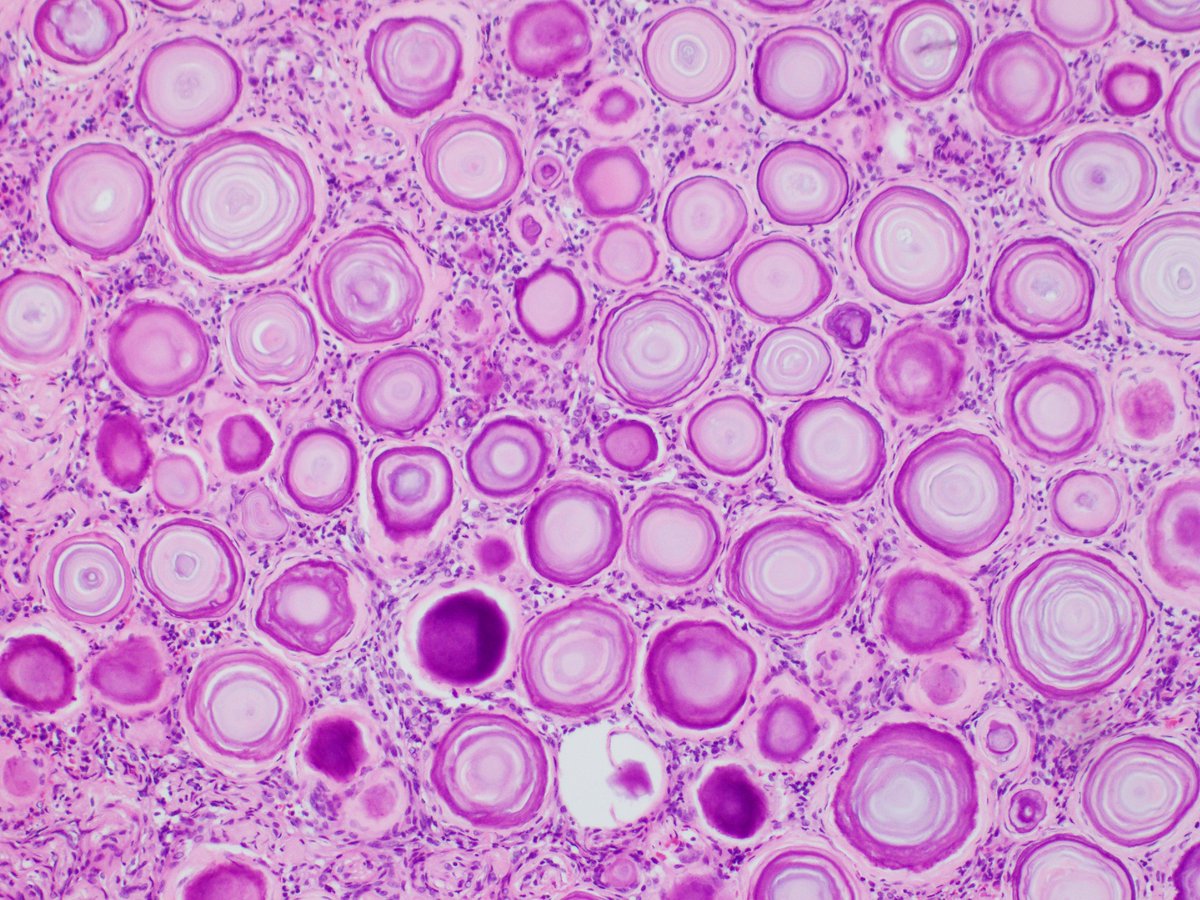 Just a pretty #meningioma