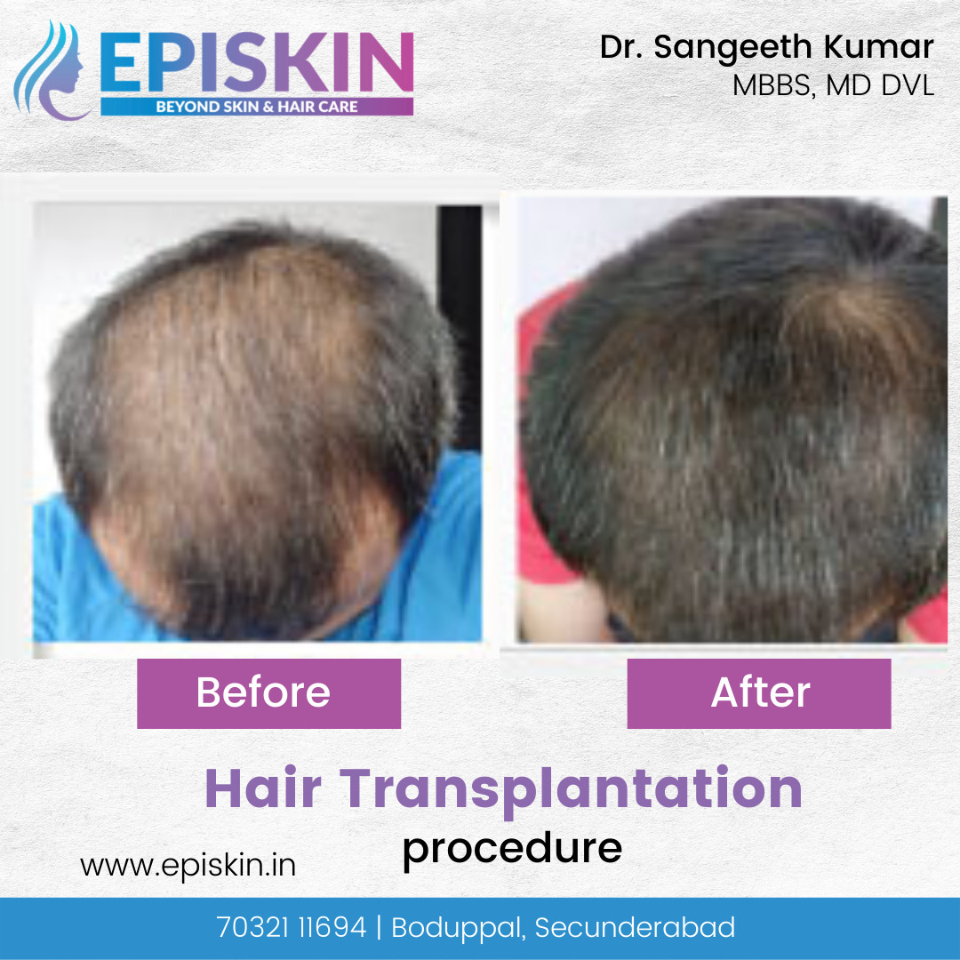 Episkin Mesh episkinclinic (@episkinclinic) / Posts / X