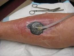 gemlrgroup's tweet photo. The 1st #RCT on negative pressure wound therapy (NPWT) in @LancetGH suggests no clinical benefit of using NPWT for conflict-related extremity wounds. In resource-limited settings, money &amp; resources required for this therapy may be better utilized elsewhere https://t.co/SU9wAaLSgk https://t.co/tH3TyJ85pk