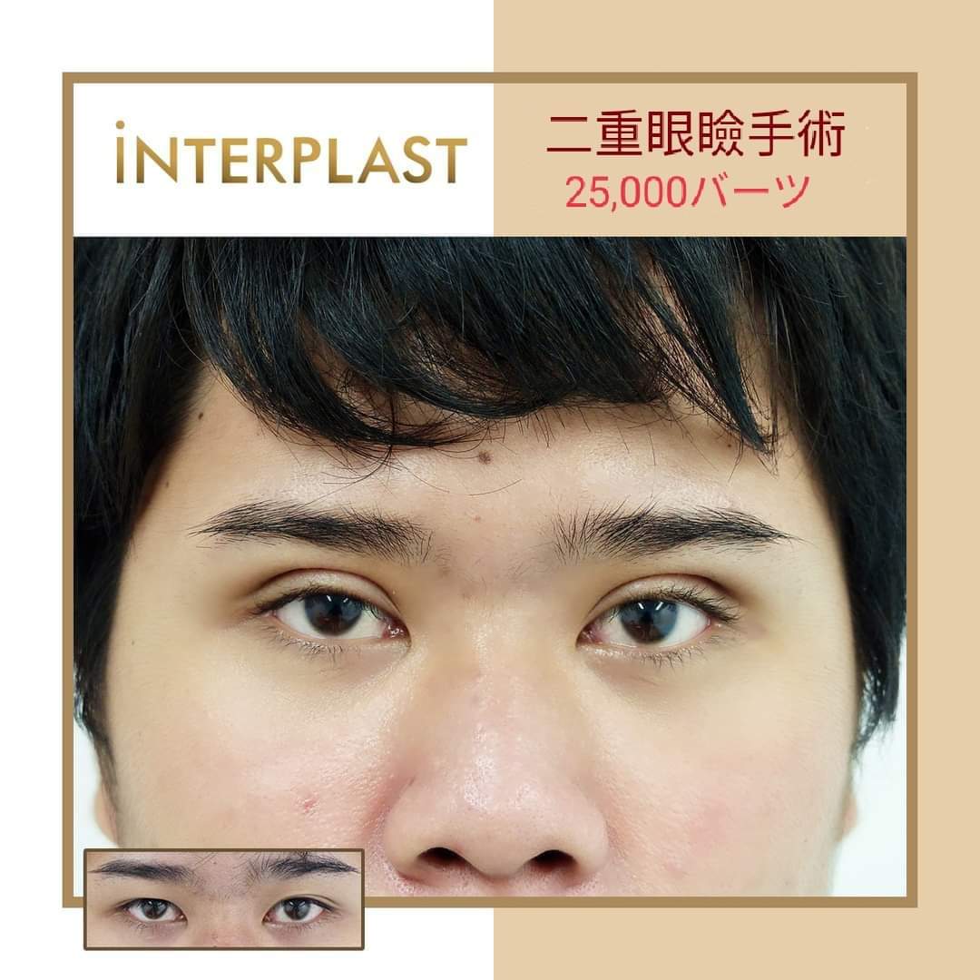 InterplastJP's tweet image. #二重手術 美しい目が手に入り、自然に見えます！
眼瞼下垂の問題が解決します。
まぶたと余分な脂肪をカットします。値段は25,000バーツです。#追徴なし

あなたの写真と理想の二重まぶたの写真をラインで送って、外科医に相談できます。

お問い合わせは
Line ID : @interplastjp

#インタープラスト