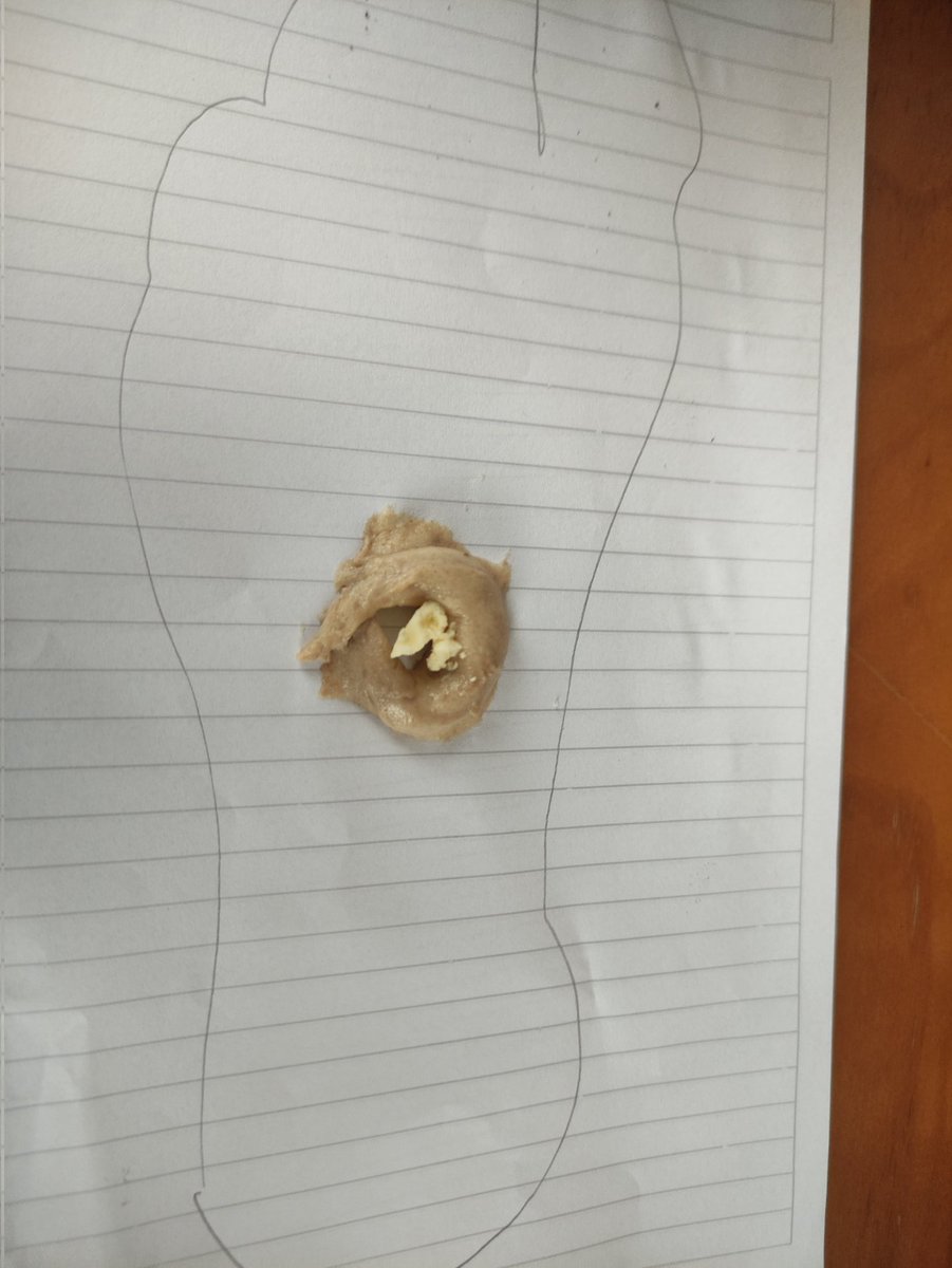 3933Mer's tweet image. Yaparsınız yapmazsınız ama bize küçükken paslı çivi battığı zaman ayağımıza uygulanan buydu,1.resimdeki ayak tabanı, hamur içindeki siyah nokta çivi batan yer, etrafı hamurla çevrilir 2. Resimdeki hamur içindeki görünen tereyağı ufak bir parça olması kâfi 🔽🔽🔽