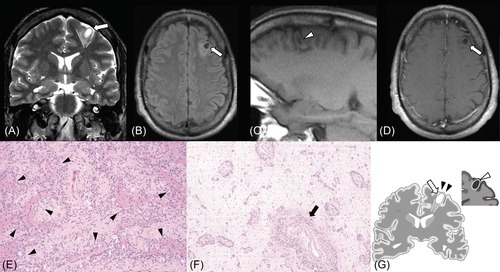 JNeuroimaging's tweet photo. Would you have recognized the stalk-like #neuroimaging features of this angiocentric #glioma #braintumor? Only half have it, but other features can reveal this rare tumor type. #radres #neurosurgery #pedneuro #neurology #neurotwitternetwork #neuroonc
https://t.co/5SbYxS414H https://t.co/kMTfPv1rfW