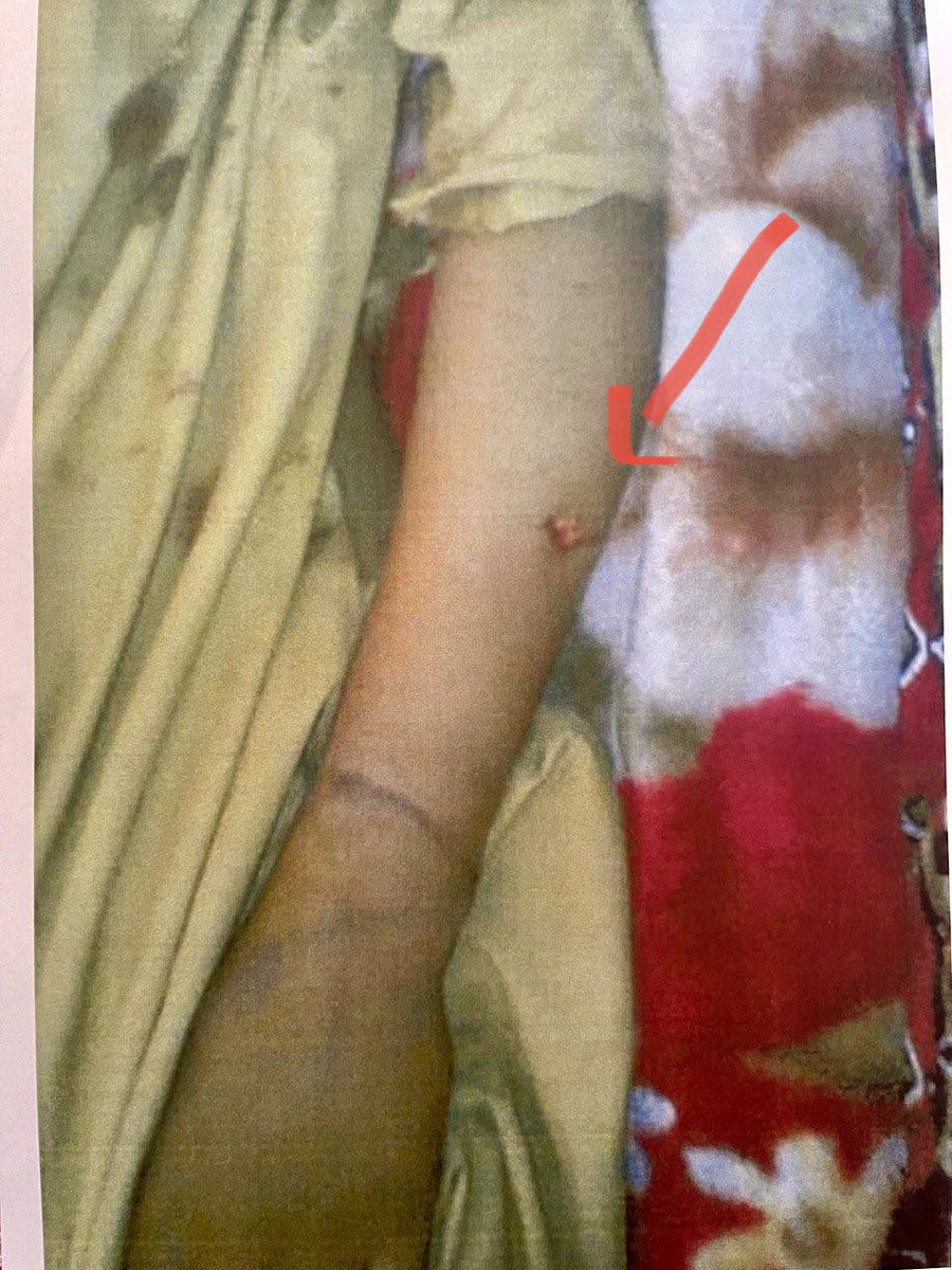 SarainBaloch's tweet photo. A decade ago Pakistani army had thrown the tortured body of my teenage brother Majeed, on trashes. 
The 🚬 spots show the state frame of mind towards #Baloch Nation. 
How can @UAE hand over a parson to a state where his family already killed and tortured.
#UAEReleaseHafeezZehri https://t.co/uoYT8JYQW7