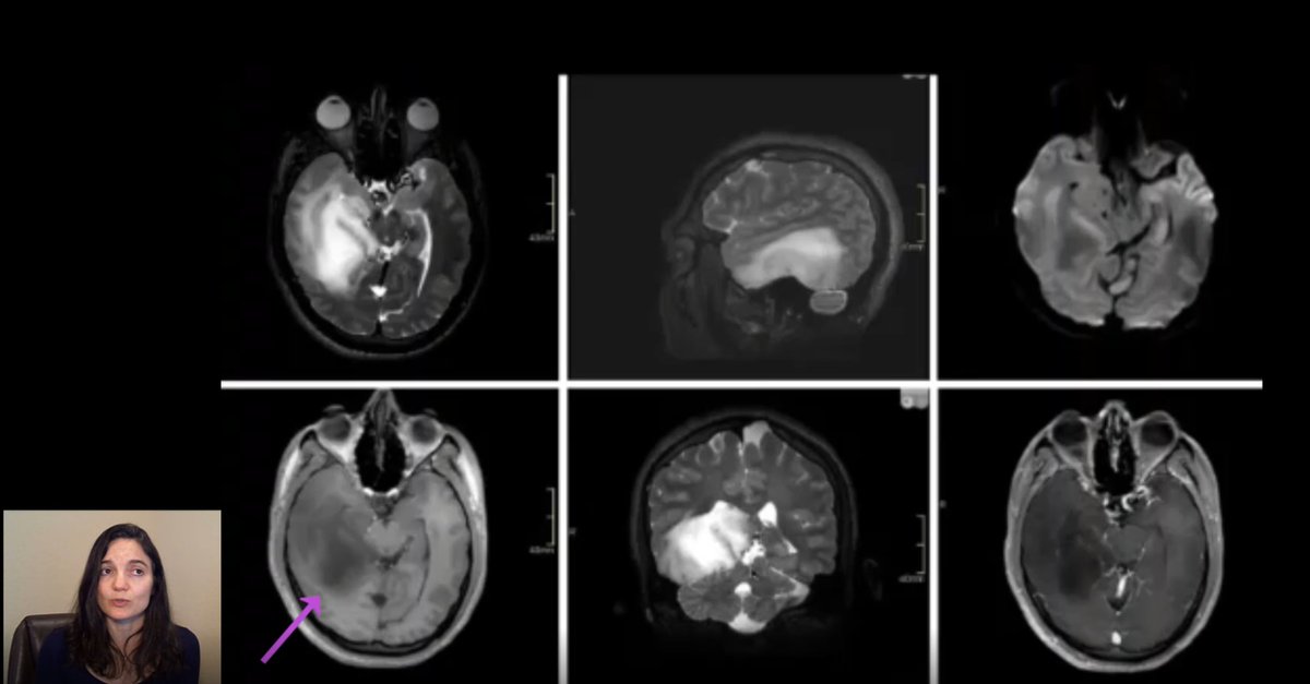 Video: IDH – Mutant Astrocytoma: Update from the 5th Edition WHO Classification of CNS Tumors
adventuresinneuropathology.com/2022/03/06/vid…
#pathology #Brain #neuropathology #neuropath   #neuroradiology  #CNS #neuro #WHO #glioblastoma  #astrocytoma #glioma #IDH