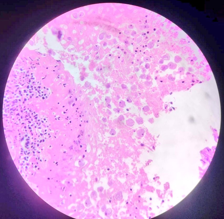 RK_Path's tweet photo. Amoebic Colitis
#pathology #GIpath https://t.co/BUZtC1lbPJ