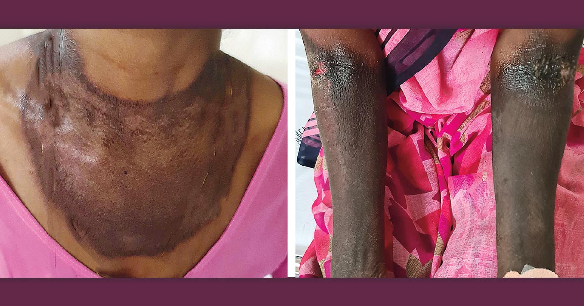 A 48-year-old woman who lived in rural India presented with diarrhea, weight loss, and a rash. Physical examination showed well-demarcated areas of hyperpigmentation on the sun-exposed areas of her neck, chest, and forearms. What is the likely diagnosis? nej.md/2Ku5WxD