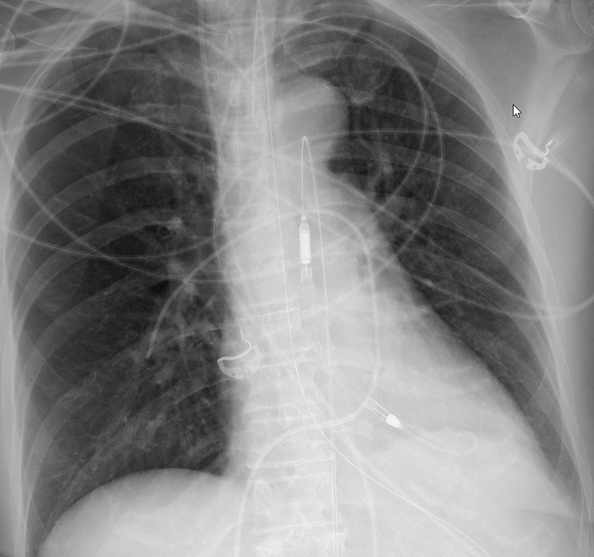 ICU stories: Middle-aged pt w remote hx of seizures had grand-mal sz at home & in the ambulance. Int...