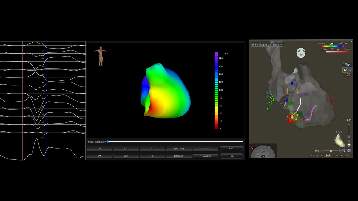 #Epeeps Ablation of symptomatic PVCs in a 19 y/o college athlete with a 30% PVC burden, nml heart by CMR and intolerance to AAD. Suppression of PVCs during procedure. VIVO map preprocedure localized SOO to inferolateral aspect of TA @CatheterInc @BiosenseWebster
