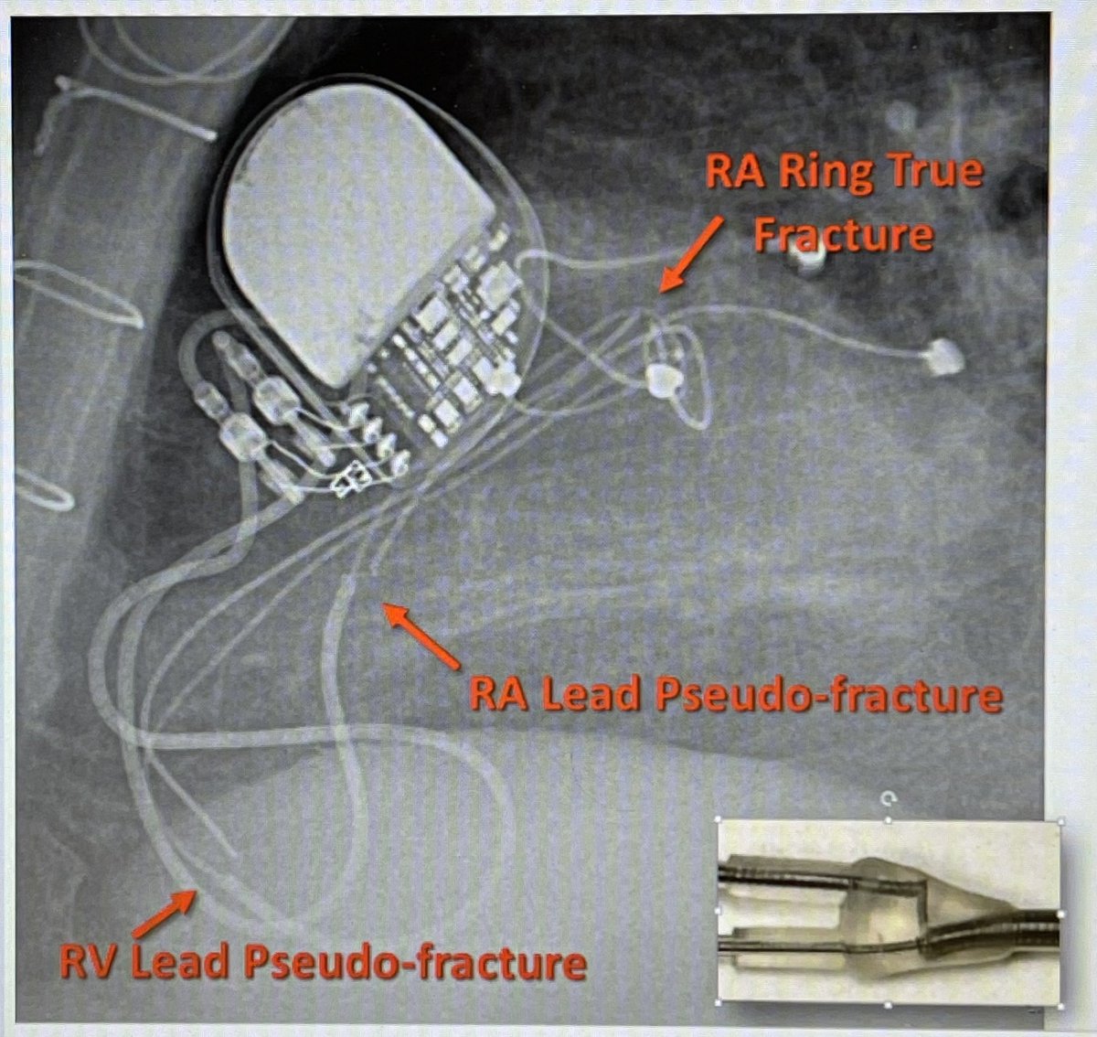 Referred a pt for gen change. Old epi leads. Numbers mostly okay, but the CXR startled me. Partial fracture? Without noise or impedance changes? <a href="/jeffrey_vinocur/">Jeffrey M Vinocur</a> set me straight and taught me about MDT 4968 leads. #EPeeps