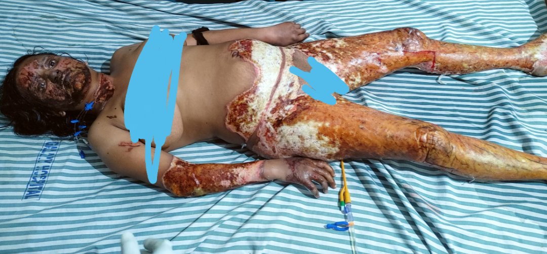 RAJADHISH's tweet photo. During Treatment Pic of 28th Feb. After seeing this much amount of burning I even can't imagine How much pain she was going through. 
#JusticeForSakshi https://t.co/f9HhWrqAV7