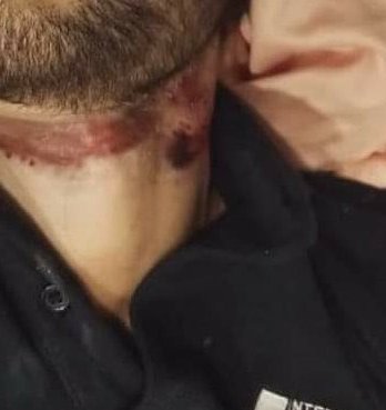 aayushlr's tweet photo. Thread Question 4
Does Stun Gun Was Used By The Murderers?
Bcuz Practically The Small Round Dotted Burn Mark Is Of Stungun &amp; The Mark On Our SSR Neck Is Like That⬇️
@ips_nupurprasad @HMOIndia 
@narendramodi Ji @PMOIndia
.
Give Democratic Rights 2 SSR 🙏🏻
Justice For Our Sushant🙌🏻 https://t.co/R2YATKeD9L