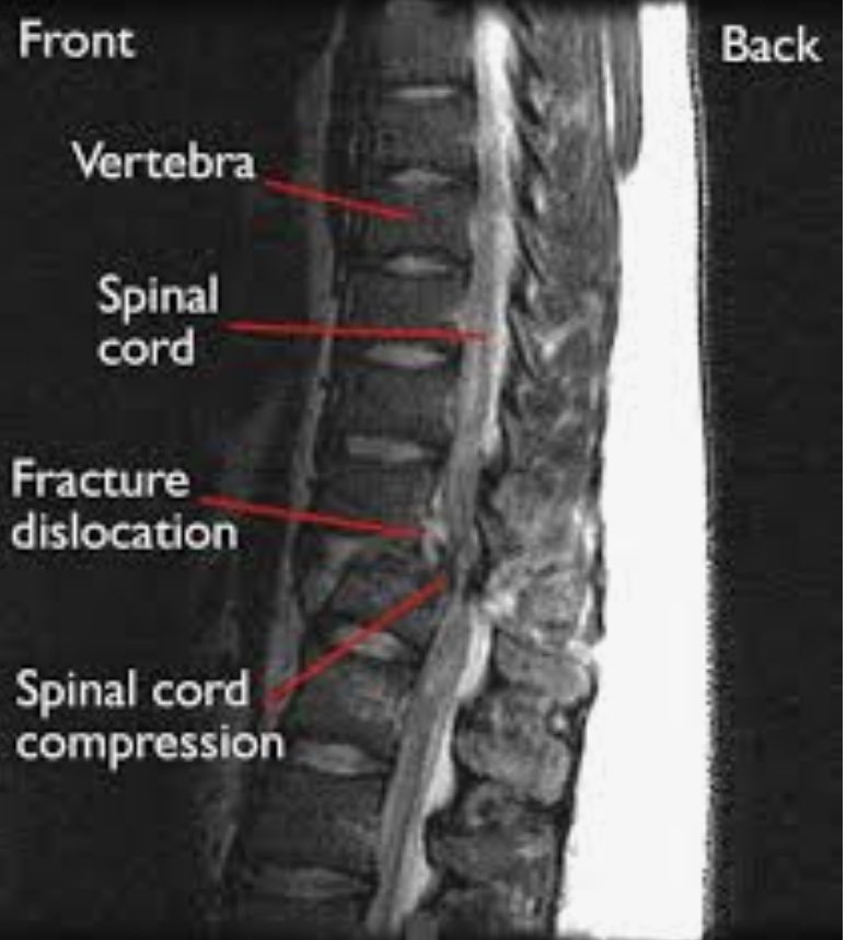 SurgJournal's tweet photo. Long-term functional outcomes after traumatic spine fractures

@SurgeryUTHSC @uthsc @DinaFiliberto @traumadoctors @EAST_TRAUMA @WesternTrauma @Me4Trauma @me4_so 

 https://t.co/24LCI652zM
(Image @AAOS1 ) https://t.co/BYKBbibcoL