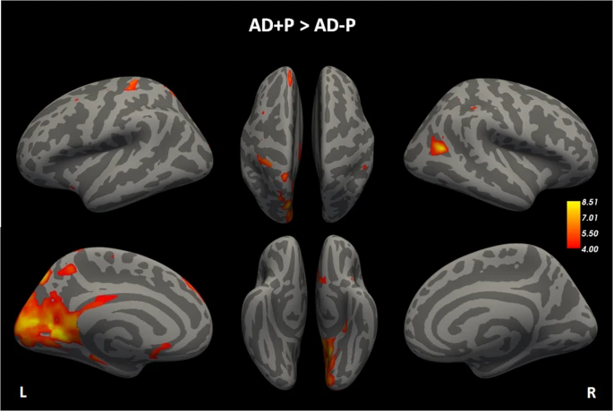 Increased retention of tau PET ligand [18F]-AV1451 in Alzheimer’s Disease Psychosis. By J.J. Gomar et al.
#openaccess #neuroscience #biomarkers #Alzheimers
nature.com/articles/s4139…