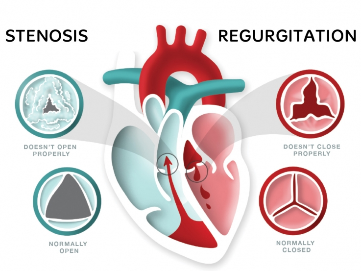 CardioVisualApp's tweet photo. Did you know that >2/3 of heart valve disease patients knew little to nothing about their condition before their diagnosis? Have your patients learn more about valve disease with Dr. Oluseun Alli, MD on #CVHealthTalks: https://t.co/TtLiTcoQb0
@valvediseaseday @Aging_Research https://t.co/G8Bi0OGU8Z