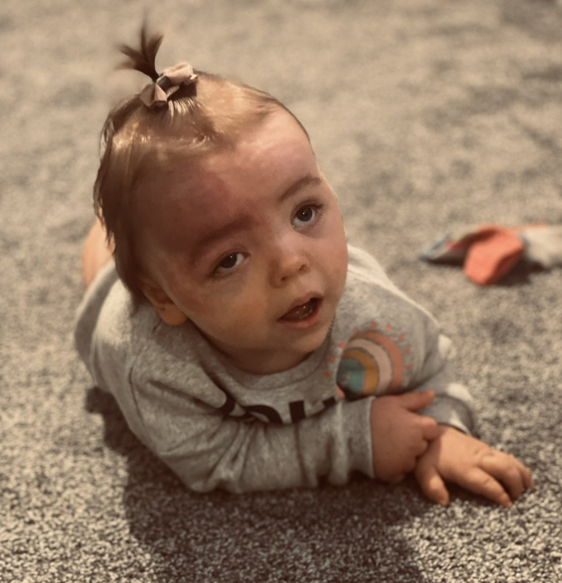 mikewoodman9's tweet photo. She still faces many challenges along the way, but the simple fact is without the NHS and Great Ormond Street she wouldn’t be here and for that we are forever grateful #NHS #GOSH #Eplilepsy #SturgeWeber #Beautifullymarked #brainsurgery https://t.co/J14S1Bj4vP