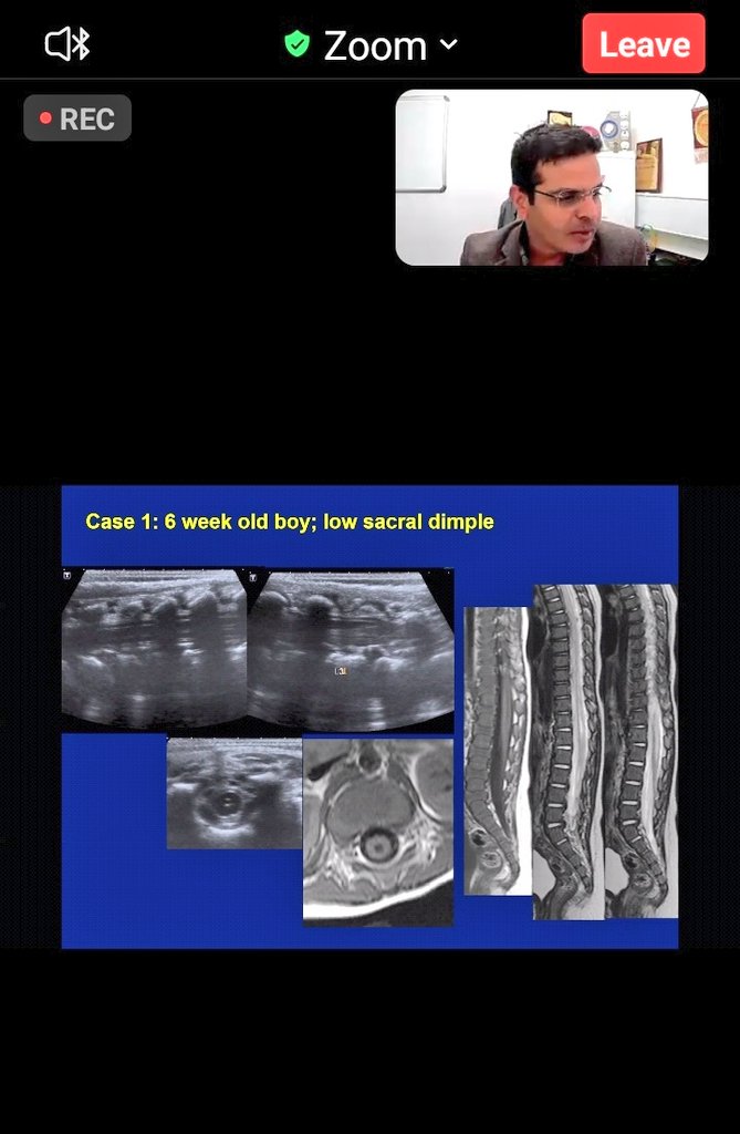 nihaal08's tweet image. Dr Kish Mankad @drmankad is live with spinal dysraphisms at the @theBSNR Pediatric Neuroimaging module.
Protocols Semantics Embryology clinics and Imaging..simplistic but effective approach to complex disorders..
@harshita_mv