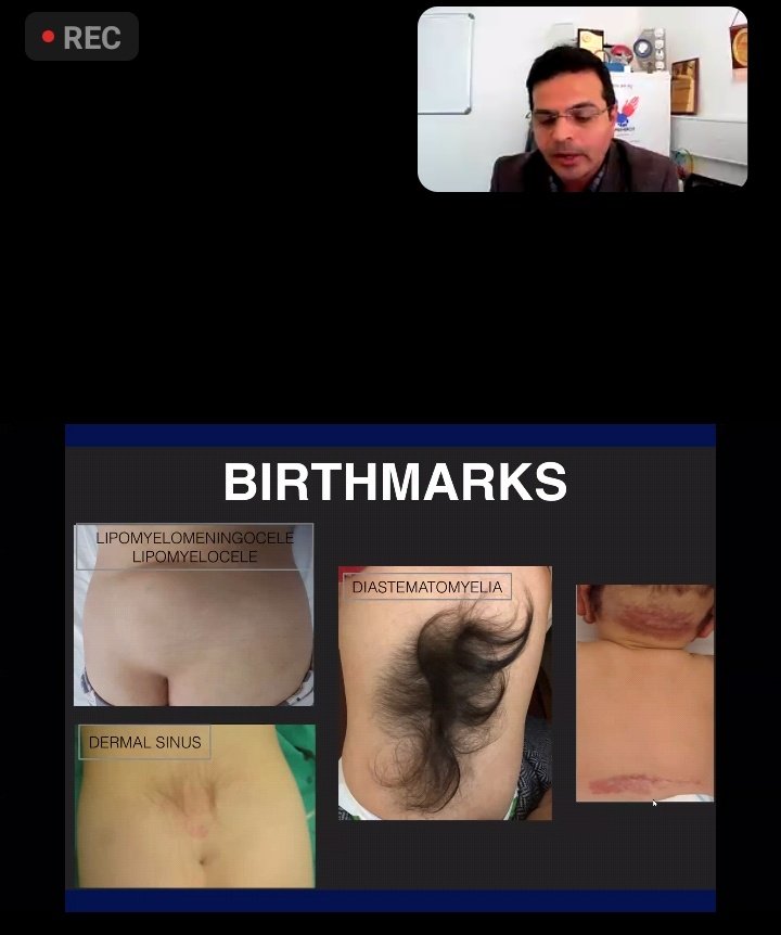 nihaal08's tweet image. Dr Kish Mankad @drmankad is live with spinal dysraphisms at the @theBSNR Pediatric Neuroimaging module.
Protocols Semantics Embryology clinics and Imaging..simplistic but effective approach to complex disorders..
@harshita_mv