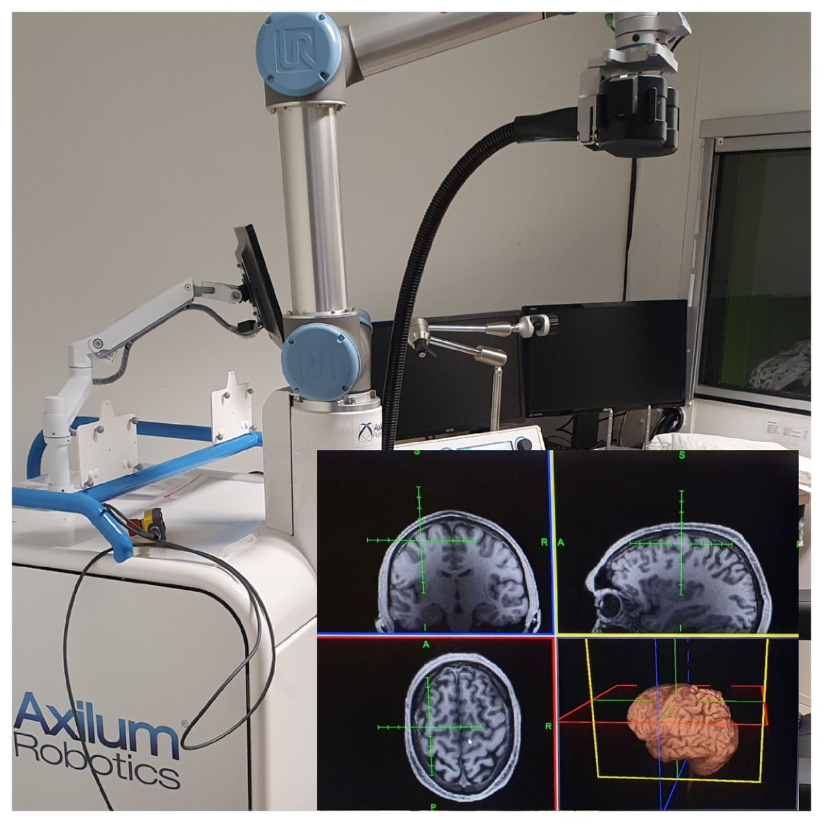 Wolfgang Seiberl (@wolfgangseiberl) on Twitter photo This is exiting! Robot-assisted brain stimulation and neuronavigation for our <a href="/dtecbw/">dtec.bw</a> funded <a href="/mext_project/">MEXTproject</a>, <a href="/unibw_m/">UniBw M</a>. <a href="/TMSLaborRgbg/">TMS lab Regensburg</a> <a href="/axilumrobotics/">Axilum Robotics</a> <a href="/localite/">Localite GmbH</a> This is exiting! Robot-assisted brain stimulation and neuronavigation for our <a href="/dtecbw/">dtec.bw</a> funded <a href="/mext_project/">MEXTproject</a>, <a href="/unibw_m/">UniBw M</a>. <a href="/TMSLaborRgbg/">TMS lab Regensburg</a> <a href="/axilumrobotics/">Axilum Robotics</a> <a href="/localite/">Localite GmbH</a>