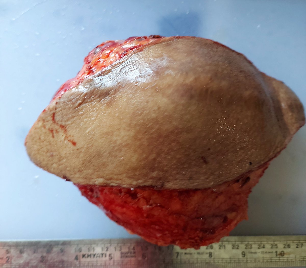 padmapathology1's tweet photo. #PathTwitter #bstpath Soft tissue mass in an elderly ♀️. What history am I hiding? #macropath #grossognosis @varunksingh @drsys02 @glinglerimek @nucleololailo @atman_ci @PoloniaAntonio @NITHYAPREM3 @aadhya__sharma @AnuSinha_patho @DrDhwanika @belurkar_sushma https://t.co/VI4lDYmSv0