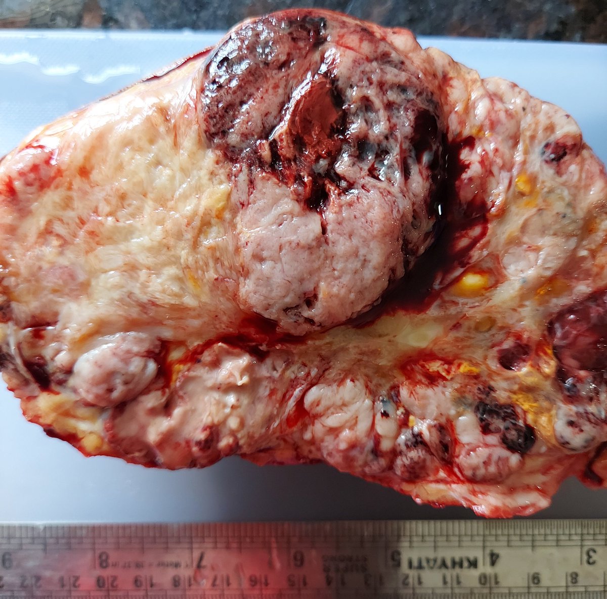 padmapathology1's tweet photo. #PathTwitter #bstpath Soft tissue mass in an elderly ♀️. What history am I hiding? #macropath #grossognosis @varunksingh @drsys02 @glinglerimek @nucleololailo @atman_ci @PoloniaAntonio @NITHYAPREM3 @aadhya__sharma @AnuSinha_patho @DrDhwanika @belurkar_sushma https://t.co/VI4lDYmSv0