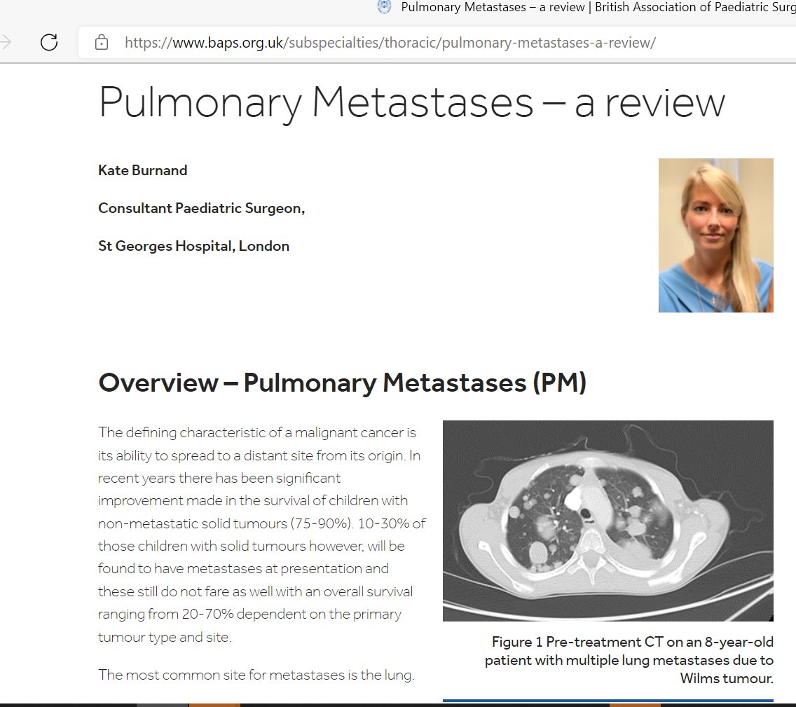 BAPS1953's tweet photo. #BAPSMember and #thoracic sub-specialty curator, Kate Burnand, @StGeorgesTrust provides a review of #PulmonaryMetastases:
https://t.co/kO962a88rA
@TriPS_PaedSurg #SoMe4Surgery https://t.co/tgKHeKPzPc
