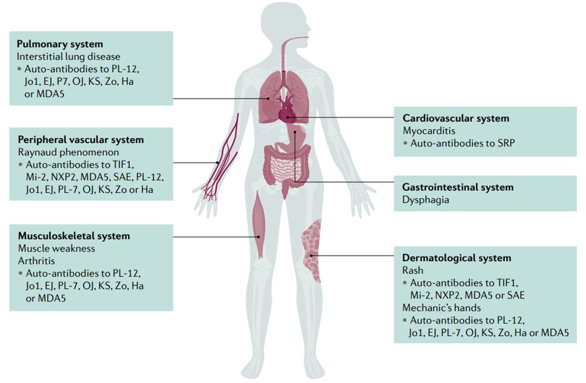DrAiLynTan's tweet photo. Idiopathic inflammatory #myopathies

🔹#Dermatomyositis
🔹Amyopathic dermatomyositis
🔹#Antisynthetase syndrome
🔹Immune mediated necrotizing #myopathy
🔹Inclusion body #myositis
🔹#Polymyositis
🔹Overlap myositis

Review
👉🏽https://t.co/WUMIDzjfJy
via @DiseasePrimers https://t.co/aME6yTKTJE